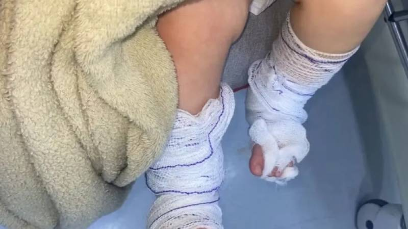 Bebê de 11 meses tem queimaduras de 2º grau após banho em escola no RS