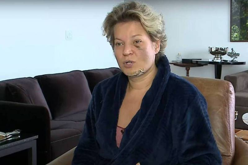 Com fraturas no rosto e no corpo, Joice Hasselmann pede investigação à Polícia Legislativa